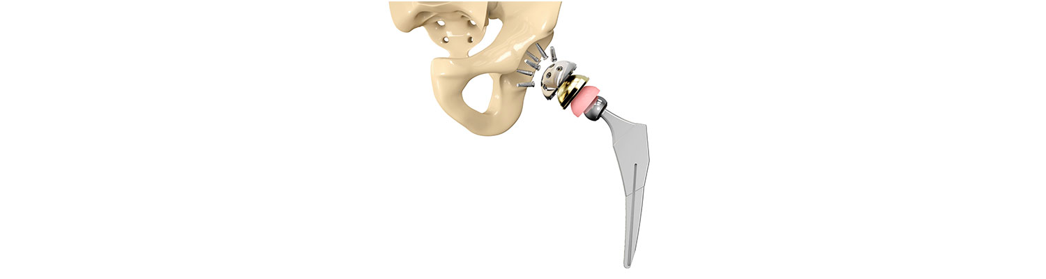 Pinnacle Hip Implant