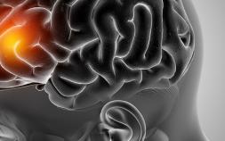 Stroke Patients Prone To Retain Gadolinium In Brain: Study