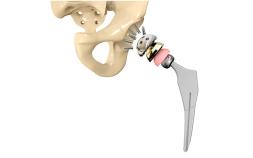 Zimmer Biomet Asks To Toss $3.55M Hip Implant Verdict